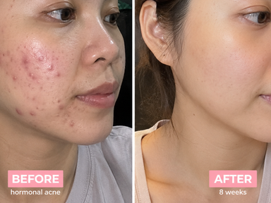Hormonal Acne Support
